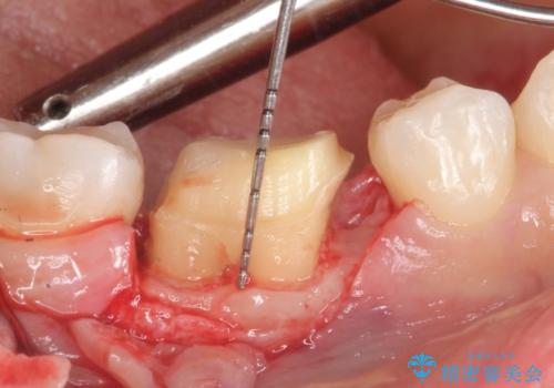 被せものが外れやすい状態を歯周外科で改善する　根管治療もやり直す