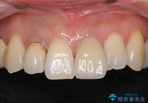 前歯が歯茎の中で折れた　部分的矯正を併用したかぶせ物の治療の治療後