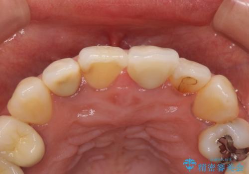 前歯が歯茎の中で折れた　部分的矯正を併用したかぶせ物の治療の治療後