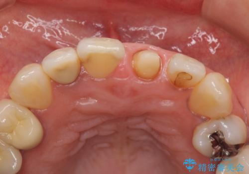 前歯が歯茎の中で折れた　部分的矯正を併用したかぶせ物の治療の治療中