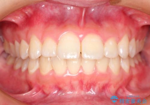 上下裏側矯正　フルリンガルによる上下前歯前突の歯列矯正の治療前