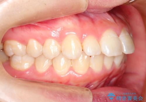 上下裏側矯正　フルリンガルによる上下前歯前突の歯列矯正の症例 治療前