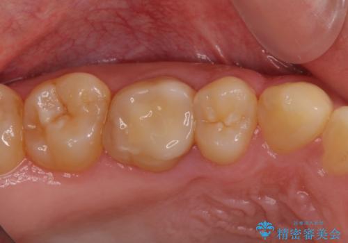 根管治療後の奥歯のセラミッククラウン治療　歯肉からの出血が改善の治療前