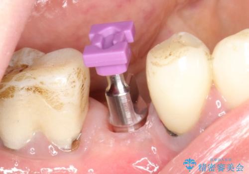 歯根破折で抜歯を余儀なくされた歯のインプラント治療