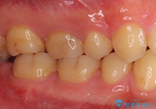 根管治療後の奥歯のセラミッククラウン治療　歯肉からの出血が改善の治療前