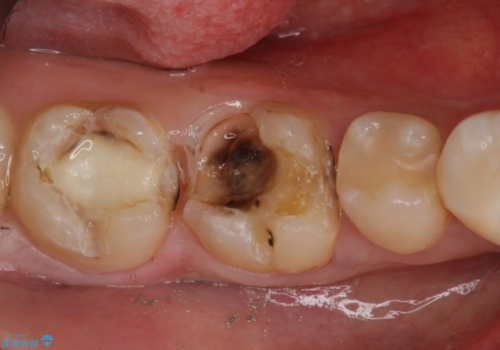銀歯をセラミックで白い歯へ　虫歯もきっちりとりますの治療中