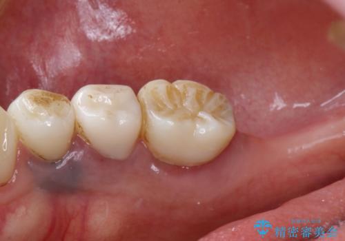 歯根破折で抜歯を余儀なくされた歯のインプラント治療の治療前