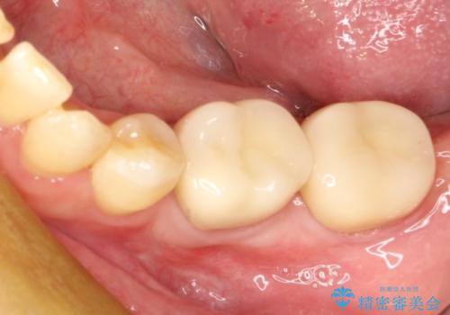 感染を生じている奥歯の根本的な治療→かみ合わせの回復の治療後