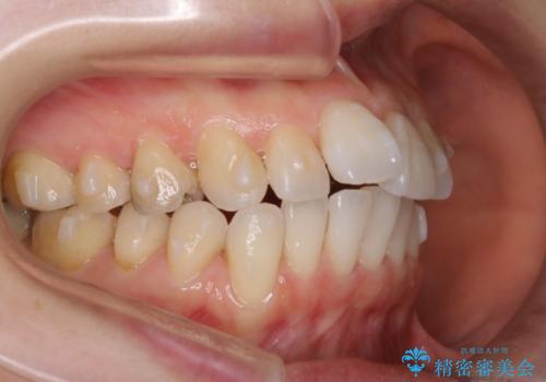 インビザライン・非抜歯　出っ歯とガタつきの矯正治療の治療中
