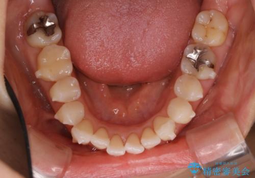インビザライン・非抜歯　出っ歯とガタつきの矯正治療の治療中