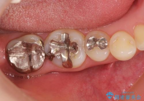 咬むと痛い　根管治療のやり直しと歯周外科を含む徹底的な治療の治療前