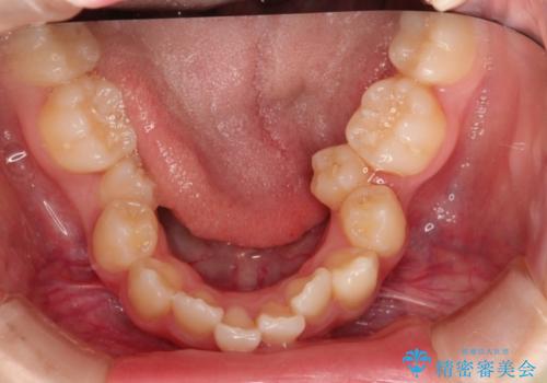 ハーフリンガルで八重歯の矯正の治療前