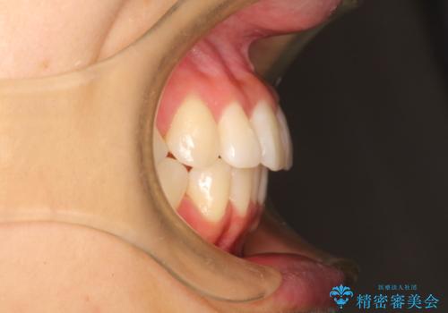 出っ歯が気になる　インビザラインによる目立たない矯正の治療後