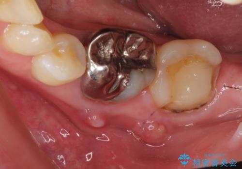 感染を生じている奥歯の根本的な治療→かみ合わせの回復の治療前