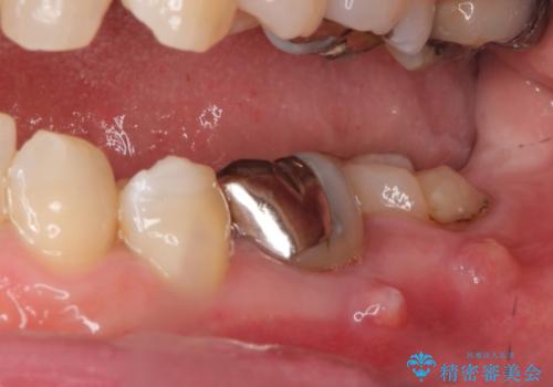 感染を生じている奥歯の根本的な治療→かみ合わせの回復