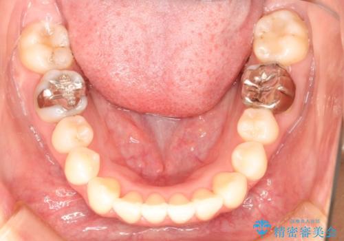出っ歯が気になる　インビザラインによる目立たない矯正の治療後
