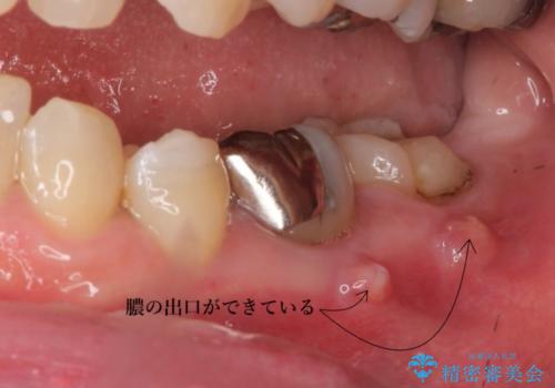 感染を生じている奥歯の根本的な治療→かみ合わせの回復の治療前