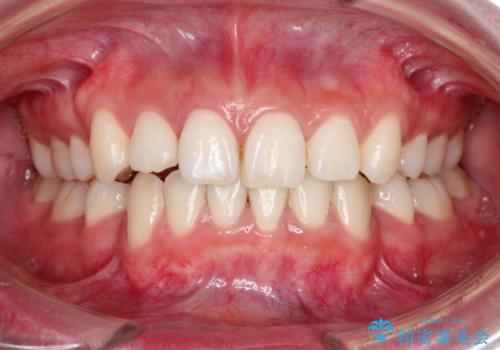 前歯の反対咬合を改善　フルリンガルの抜歯矯正の治療中