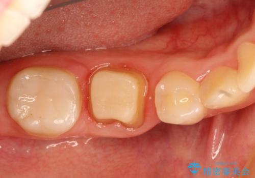 被せものが外れやすい状態を歯周外科で改善する　根管治療もやり直すの治療中