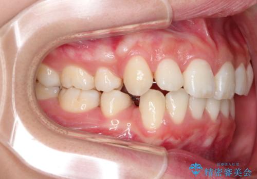 前歯の反対咬合を改善　フルリンガルの抜歯矯正の治療中