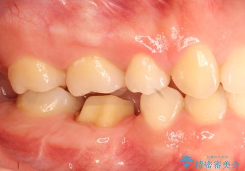 被せものが外れやすい状態を歯周外科で改善する　根管治療もやり直すの治療中