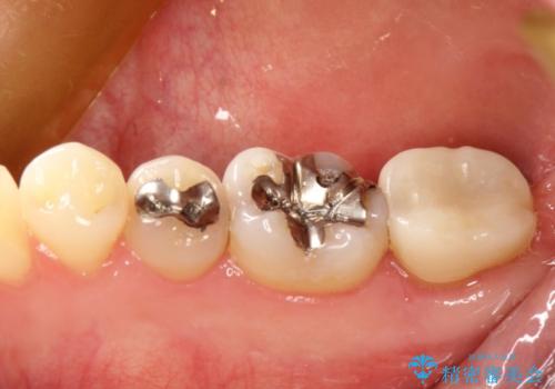 咬むと痛い　根管治療のやり直しと歯周外科を含む徹底的な治療の治療後