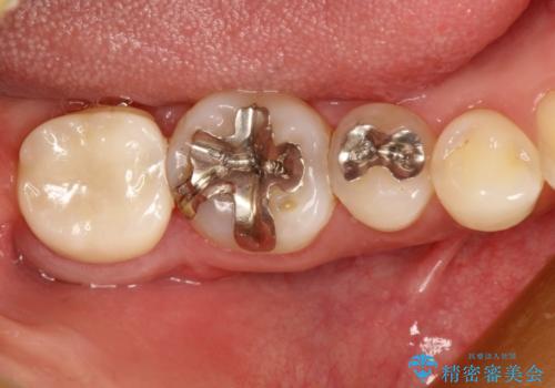 咬むと痛い　根管治療のやり直しと歯周外科を含む徹底的な治療の治療後