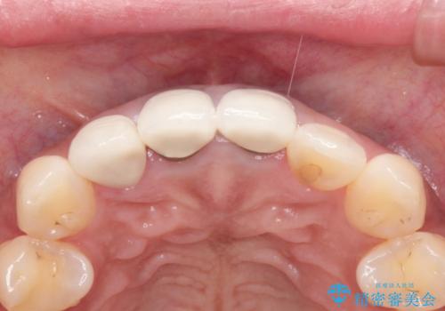 前歯部補綴　(黒ずみの改善)の治療前