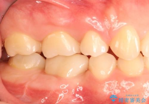 被せものが外れやすい状態を歯周外科で改善する　根管治療もやり直すの治療後