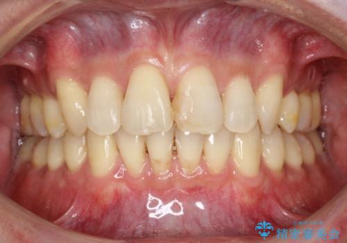 ワイヤー矯正による出っ歯の治療　表の審美装置で見た目と機能性を両立の治療後