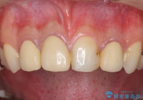 多発した前歯の虫歯　emaxクラウンによる治療の治療前