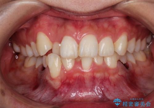 前歯の反対咬合を改善　フルリンガルの抜歯矯正の治療前