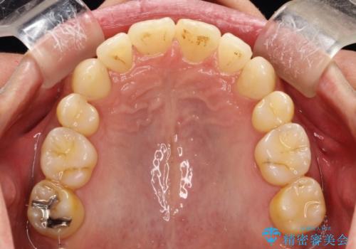ワイヤー矯正による出っ歯の治療　表の審美装置で見た目と機能性を両立の治療後