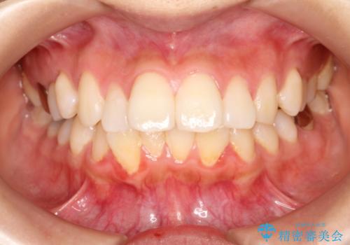 出っ歯が気になる　インビザラインによる目立たない矯正の治療前