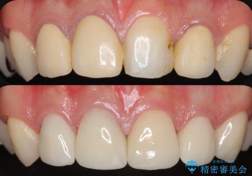 多発した前歯の虫歯　emaxクラウンによる治療