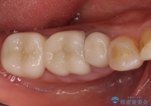 歯茎から異臭がする　大きな虫歯を抜歯してオールセラミックブリッジへの治療前