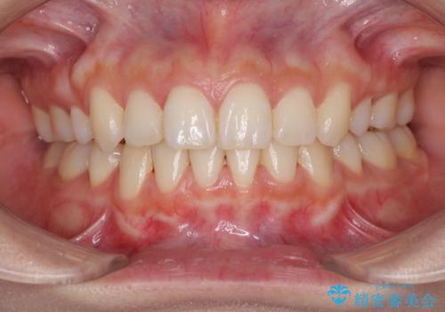 前歯の反対咬合を改善　フルリンガルの抜歯矯正