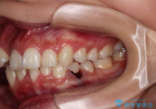 前歯の反対咬合を改善　フルリンガルの抜歯矯正の治療前