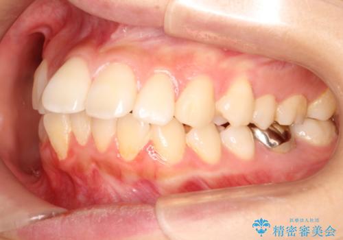 出っ歯が気になる　インビザラインによる目立たない矯正の治療前