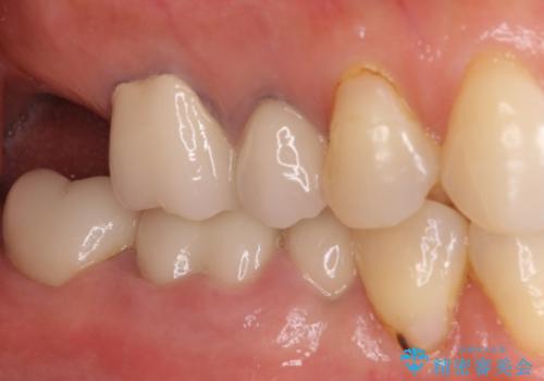歯茎から異臭がする　大きな虫歯を抜歯してオールセラミックブリッジへの治療前