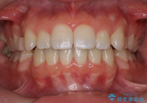 上下裏側矯正　フルリンガルによる上下前歯前突の歯列矯正の治療中