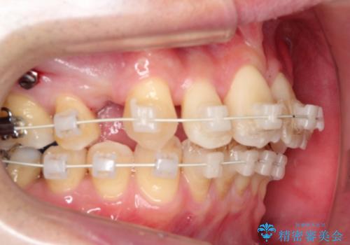 ワイヤー矯正による出っ歯の治療　表の審美装置で見た目と機能性を両立の治療中