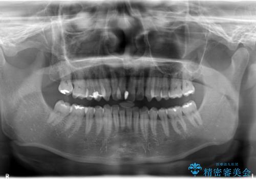 ワイヤー矯正による出っ歯の治療　表の審美装置で見た目と機能性を両立の治療前