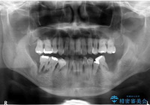 インプラント・再生治療を応用した全顎的重度歯周病治療の治療前