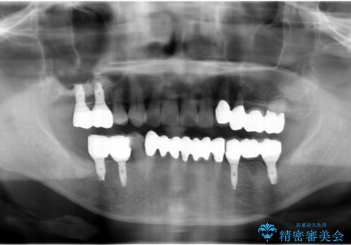 インプラント・再生治療を応用した全顎的重度歯周病治療の治療後