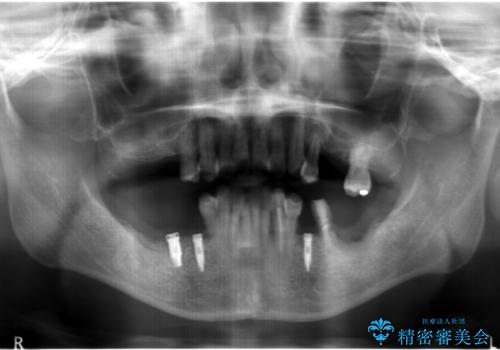 インプラント・再生治療を応用した全顎的重度歯周病治療の治療中