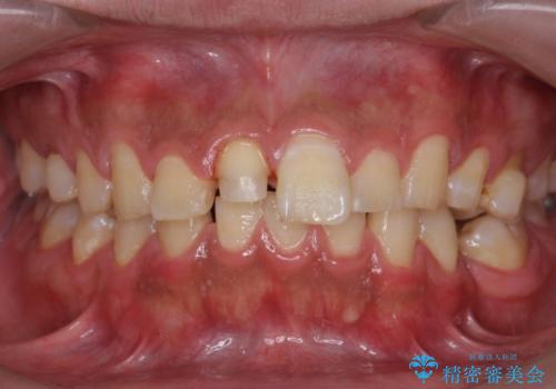 [ 前歯 審美回復 ] 治療途中からの転院　天然歯を模したセラミッククラウンの治療中