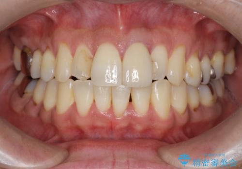 [マウスピース矯正]インビザラインによる前歯のガタつき改善の治療後
