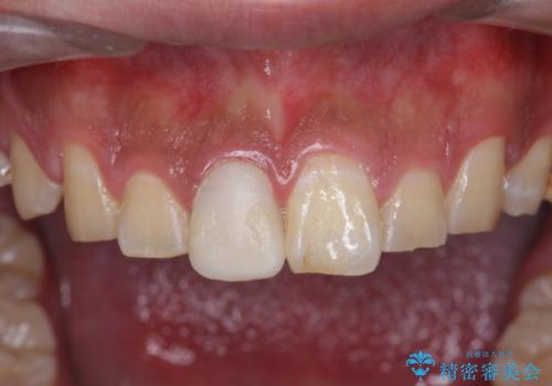 [ 前歯 審美回復 ] 治療途中からの転院　天然歯を模したセラミッククラウンの治療前