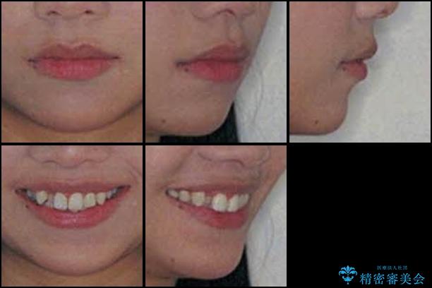 前歯の反対咬合を改善　フルリンガルの抜歯矯正の治療前（顔貌）
